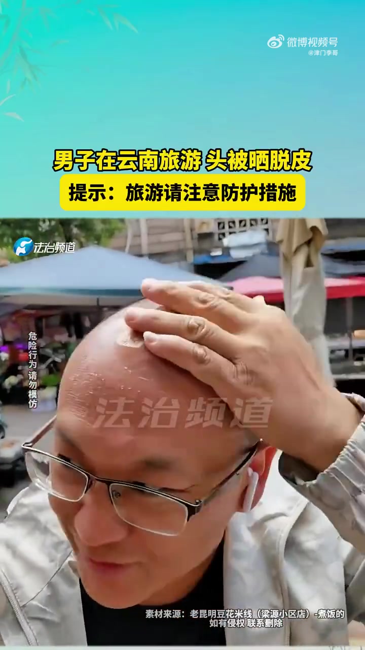 男子在云南旅游头被晒脱皮