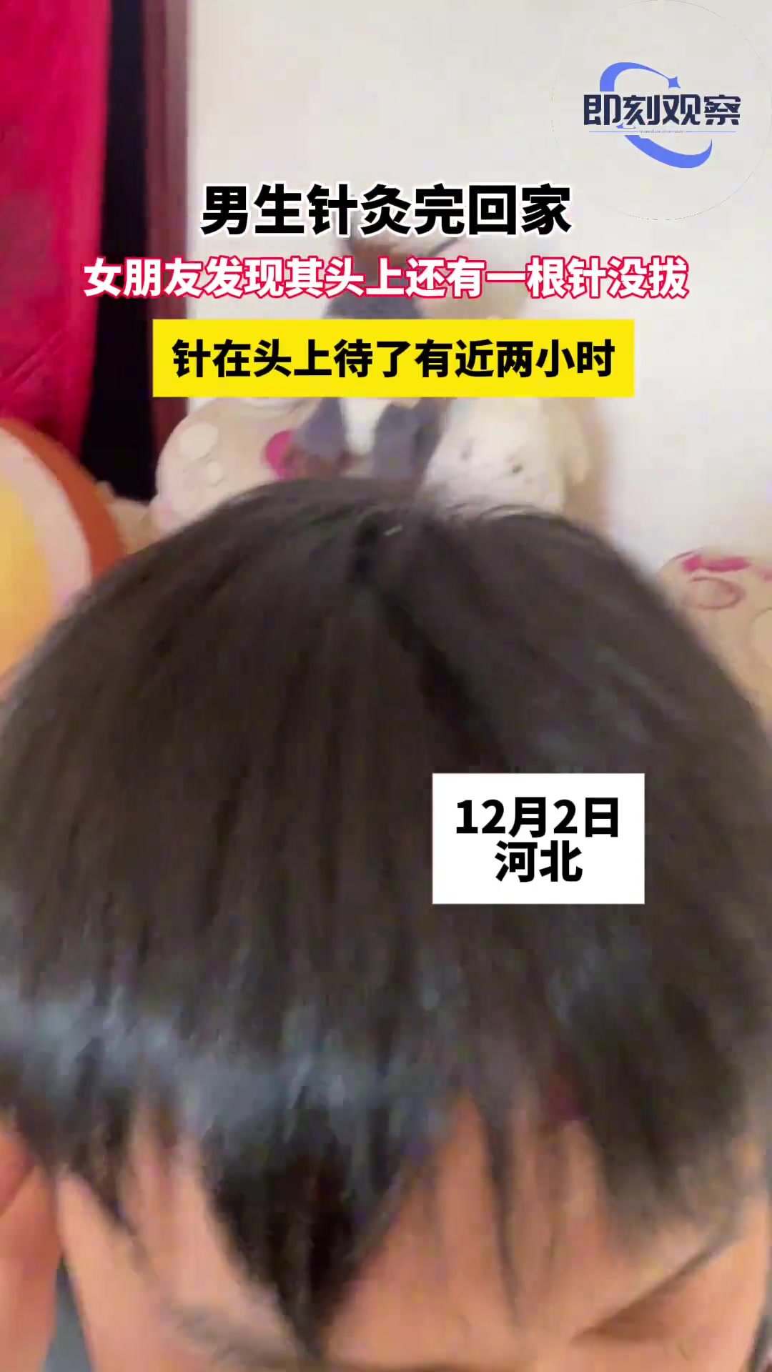 男子针灸完两小时后才发现头顶还有根针