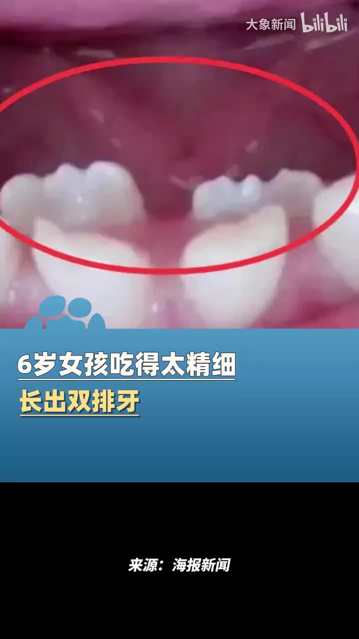 6岁女孩平日吃得太精细，竟然长出双排牙！