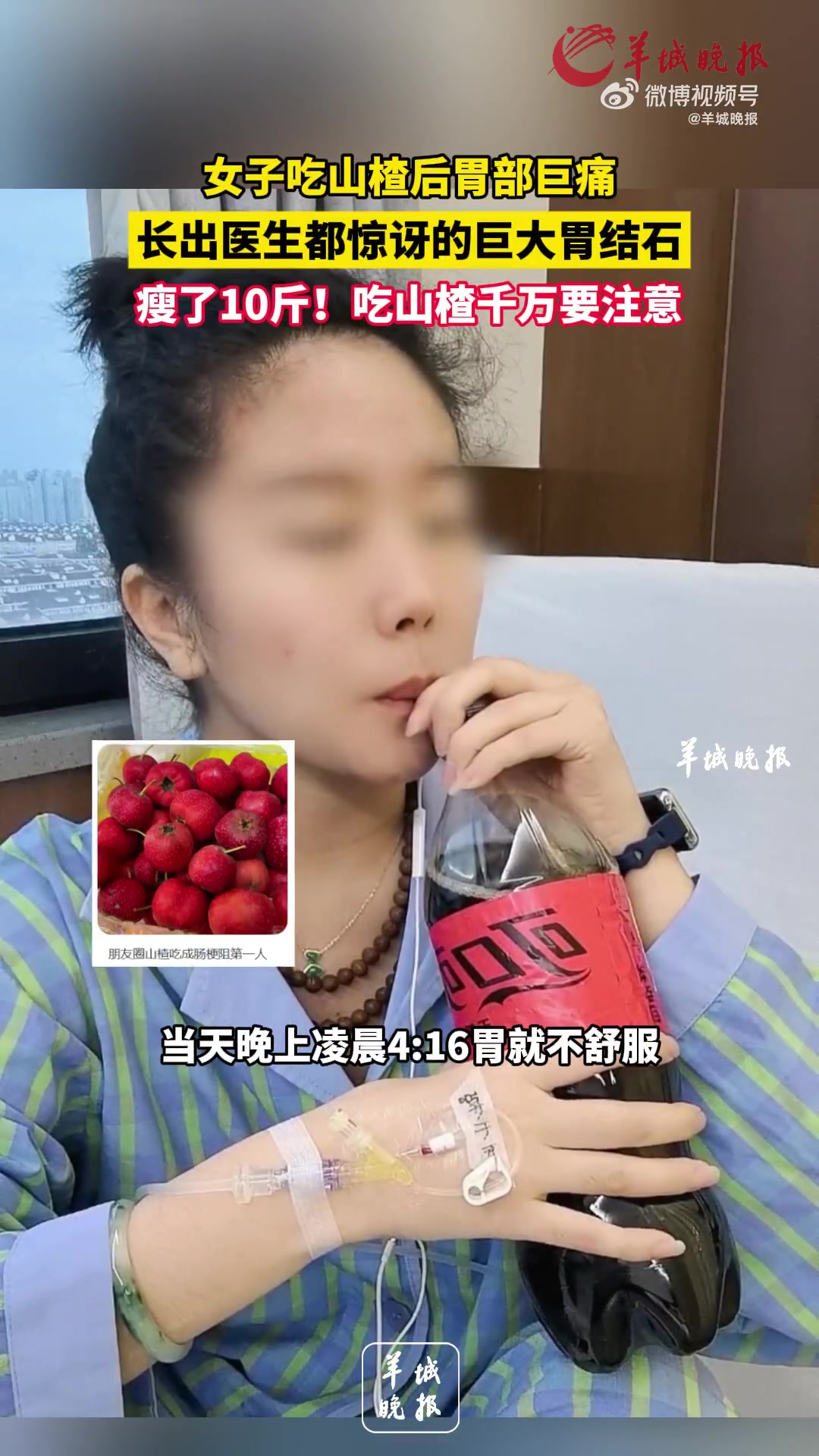 女子吃十几颗糖雪球后致巨大胃结石
