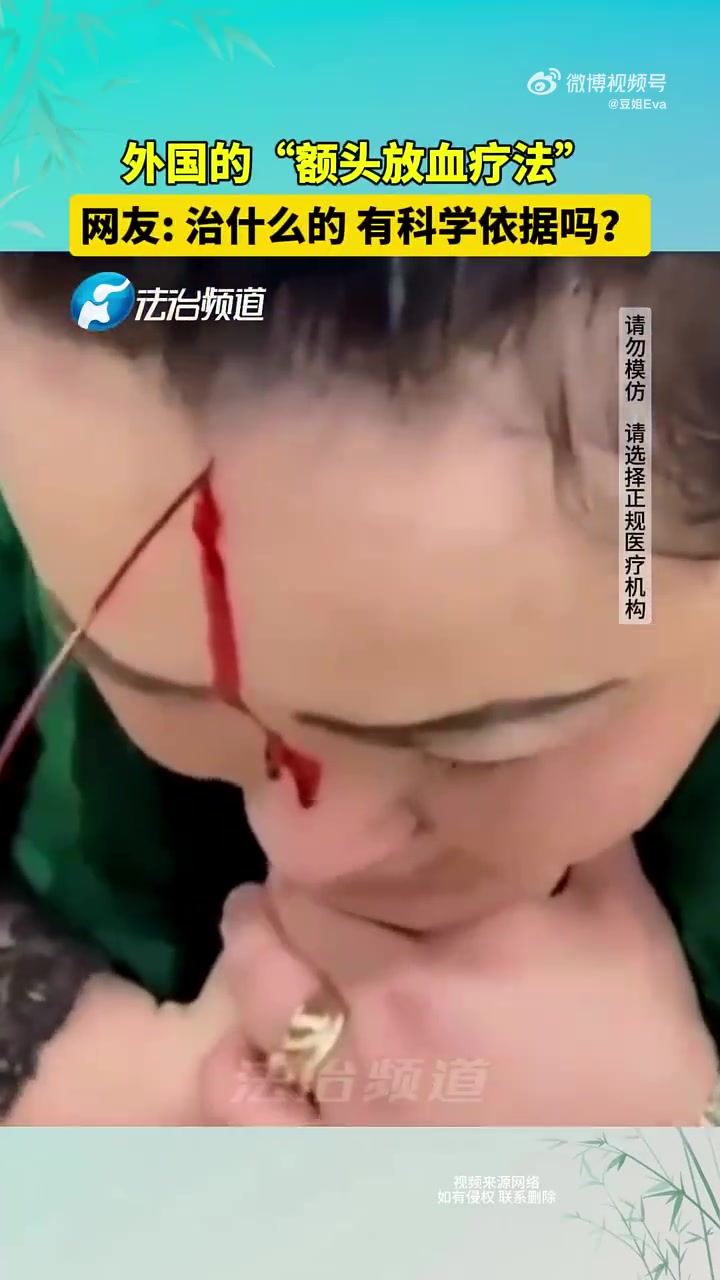 国外的“额头放血疗法”，网友有科学依据吗