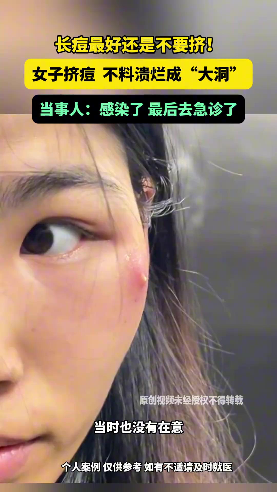 长痘最好还是不要挤女子挤痘不料溃烂成“大洞”！