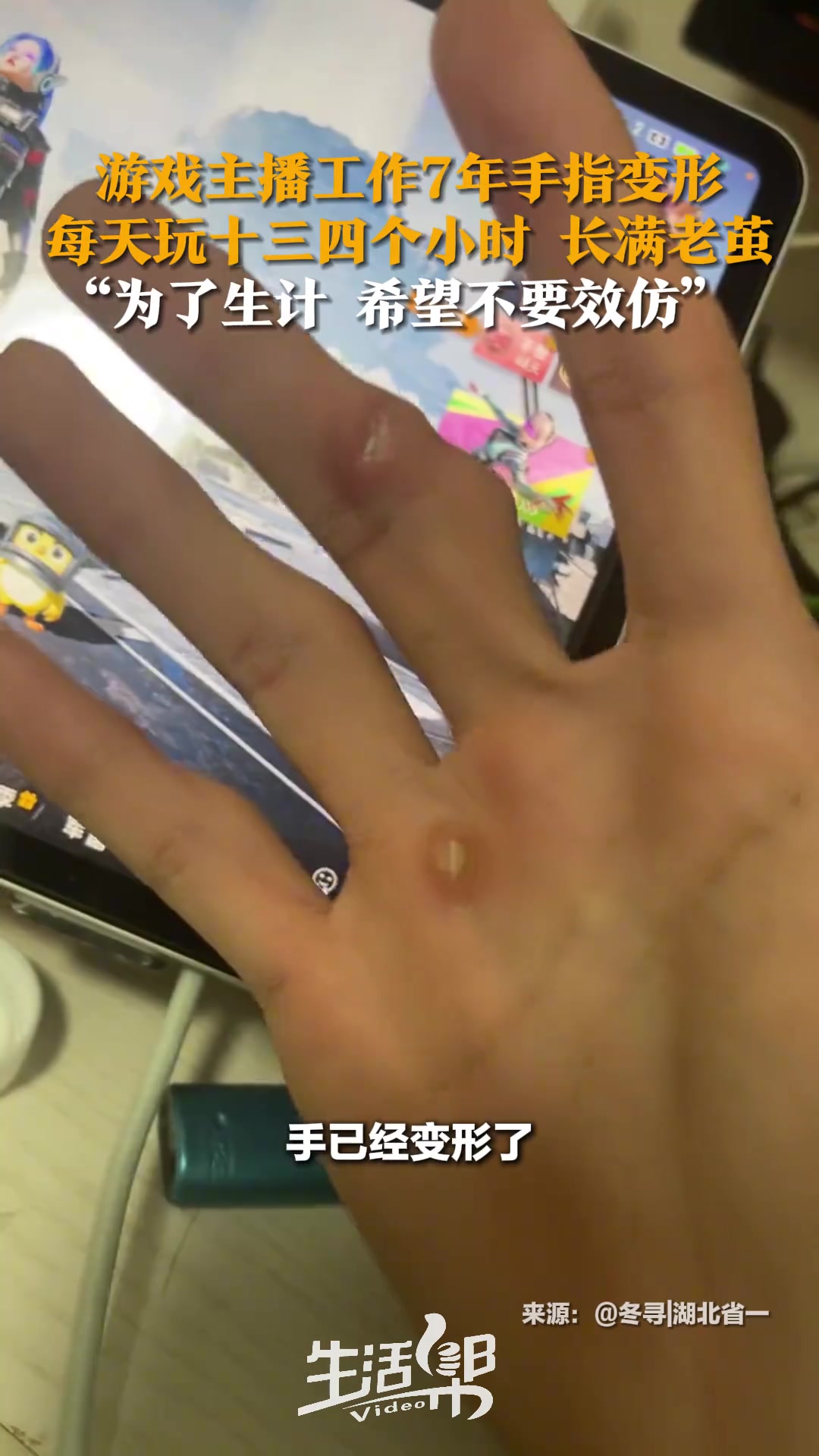 游戏主播工作7年手指严重变形每天玩十三四个小时