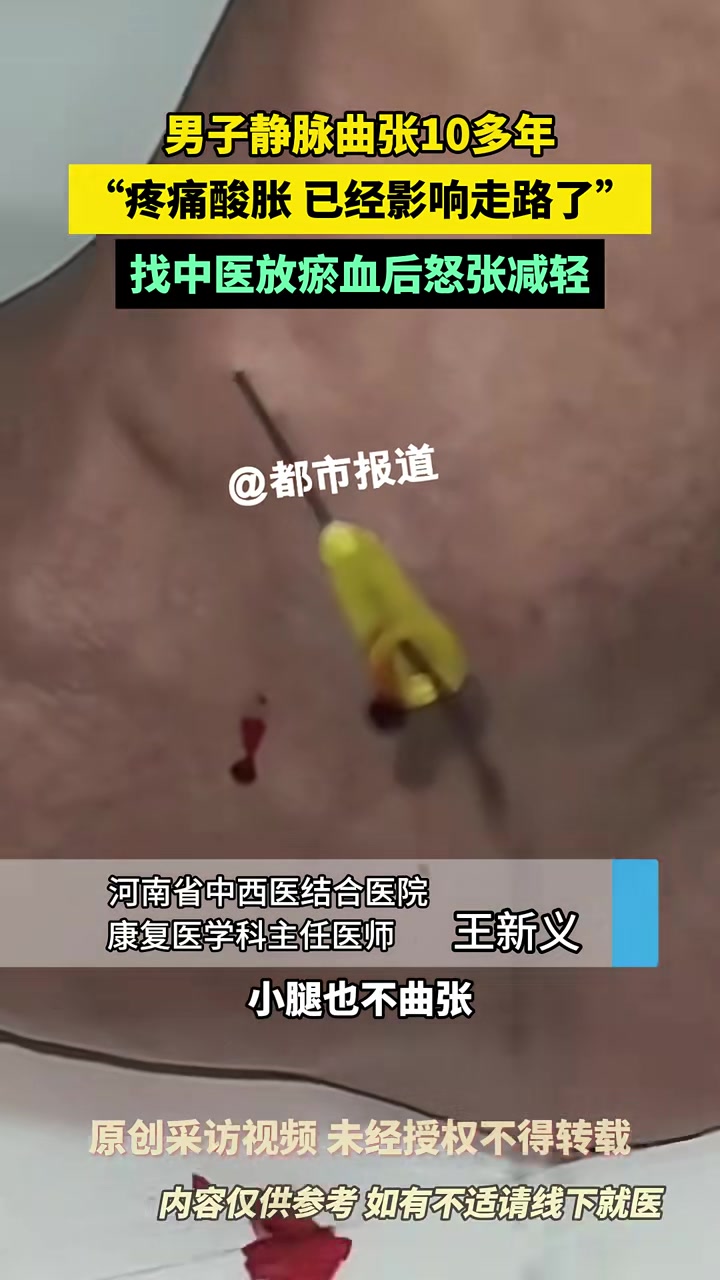 男子静脉曲张10多年，“疼痛酸胀，已经影响走路了”