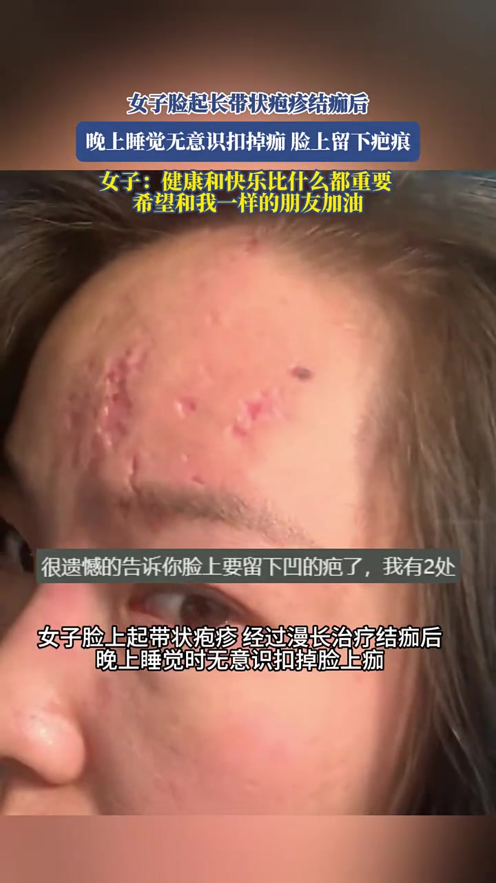 女子脸起长带状疱疹结痂后，晚上睡觉无意识扣掉痂，脸上留下疤痕