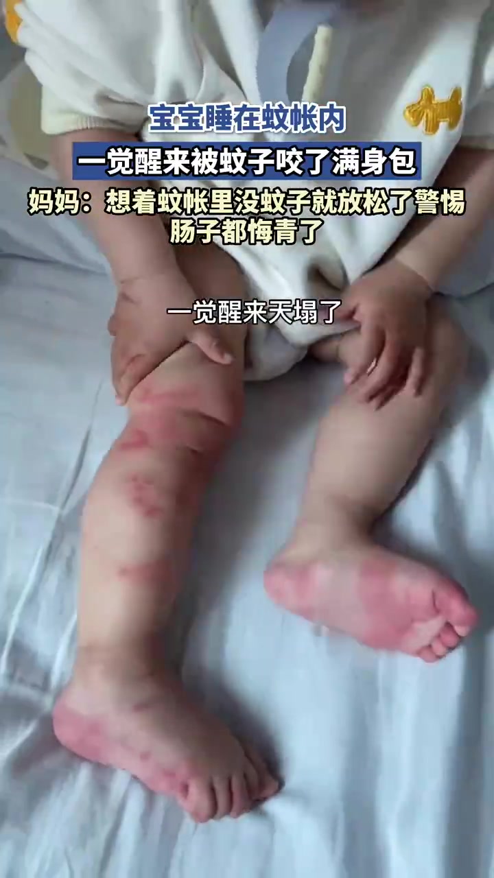 宝宝睡在蚊帐内，一觉醒来被蚊子咬了满身包