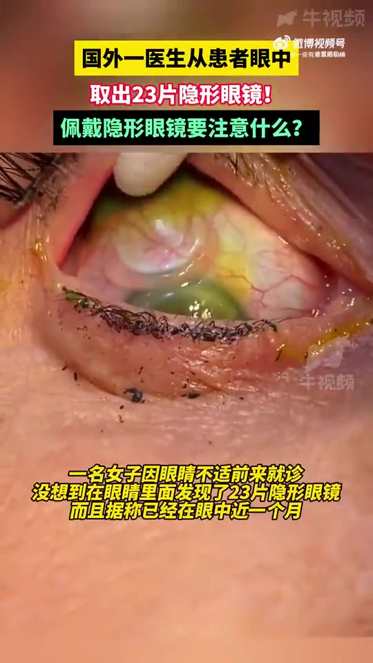 国外女子眼中竟取出23片隐形眼镜
