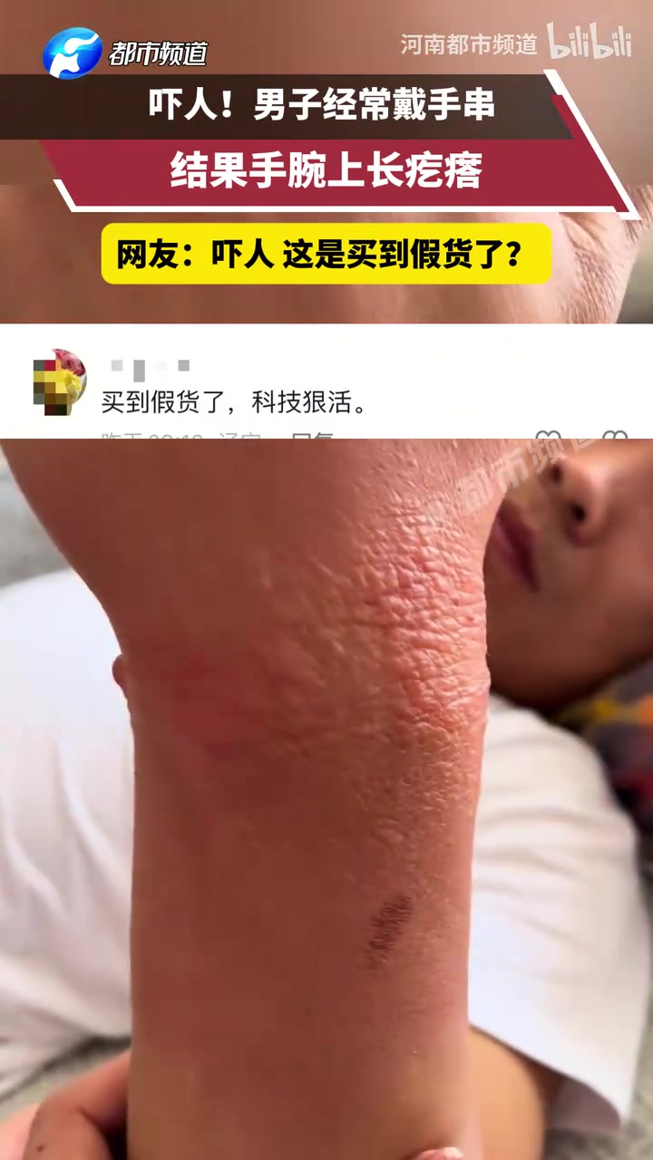 男子经常戴手串结果手腕上长疙瘩网友吓人这是买到假货了