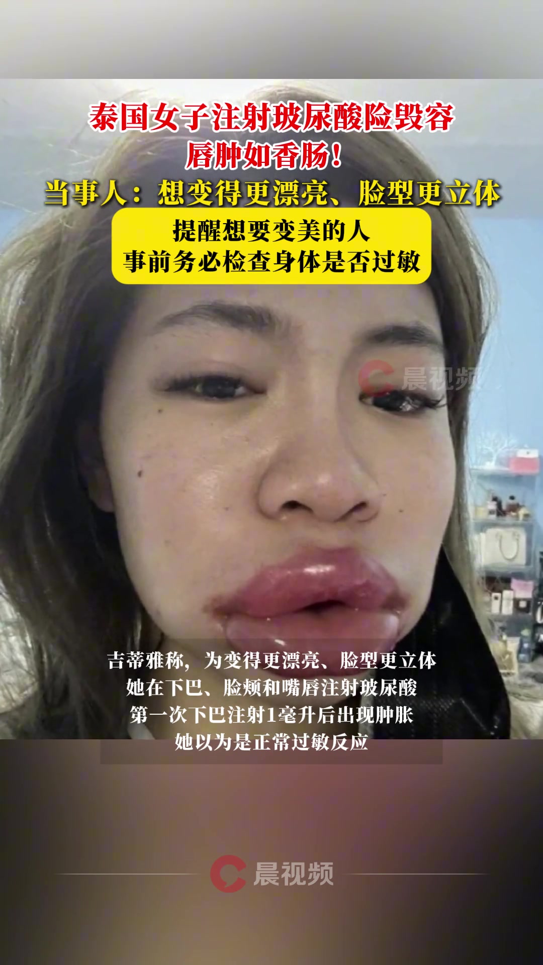 唇肿如香肠！泰国女子注射玻尿酸险毁容