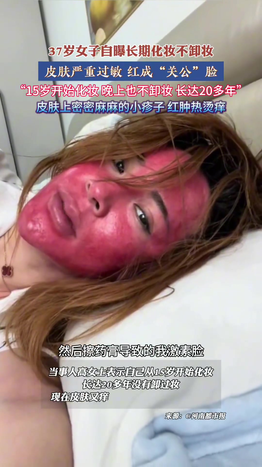 37岁女子自曝长期化妆不卸妆，皮肤严重过敏红成“关公”脸