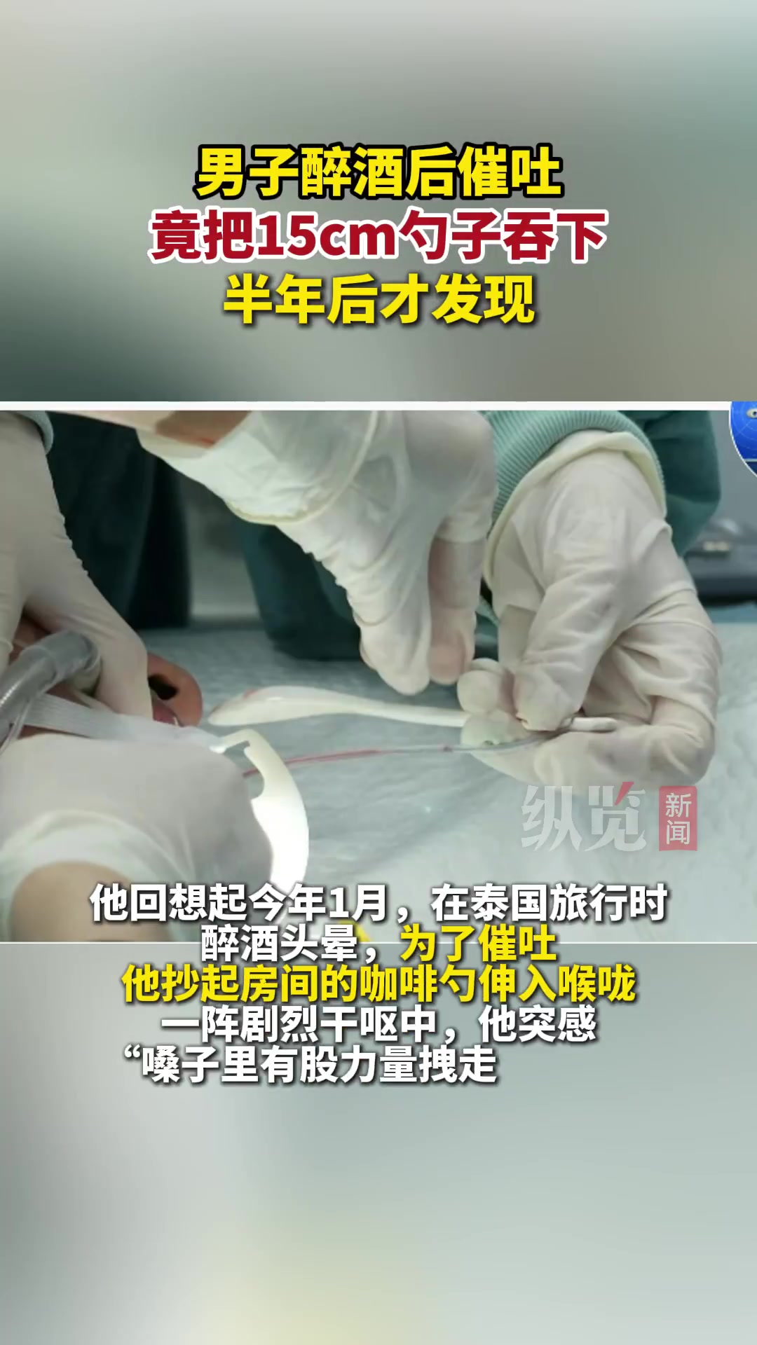 上海男子胃里藏勺半年！催吐误吞险穿孔