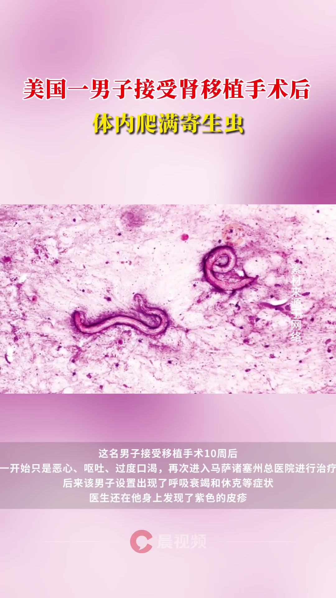美国男子肾移植术后体内爬满寄生虫