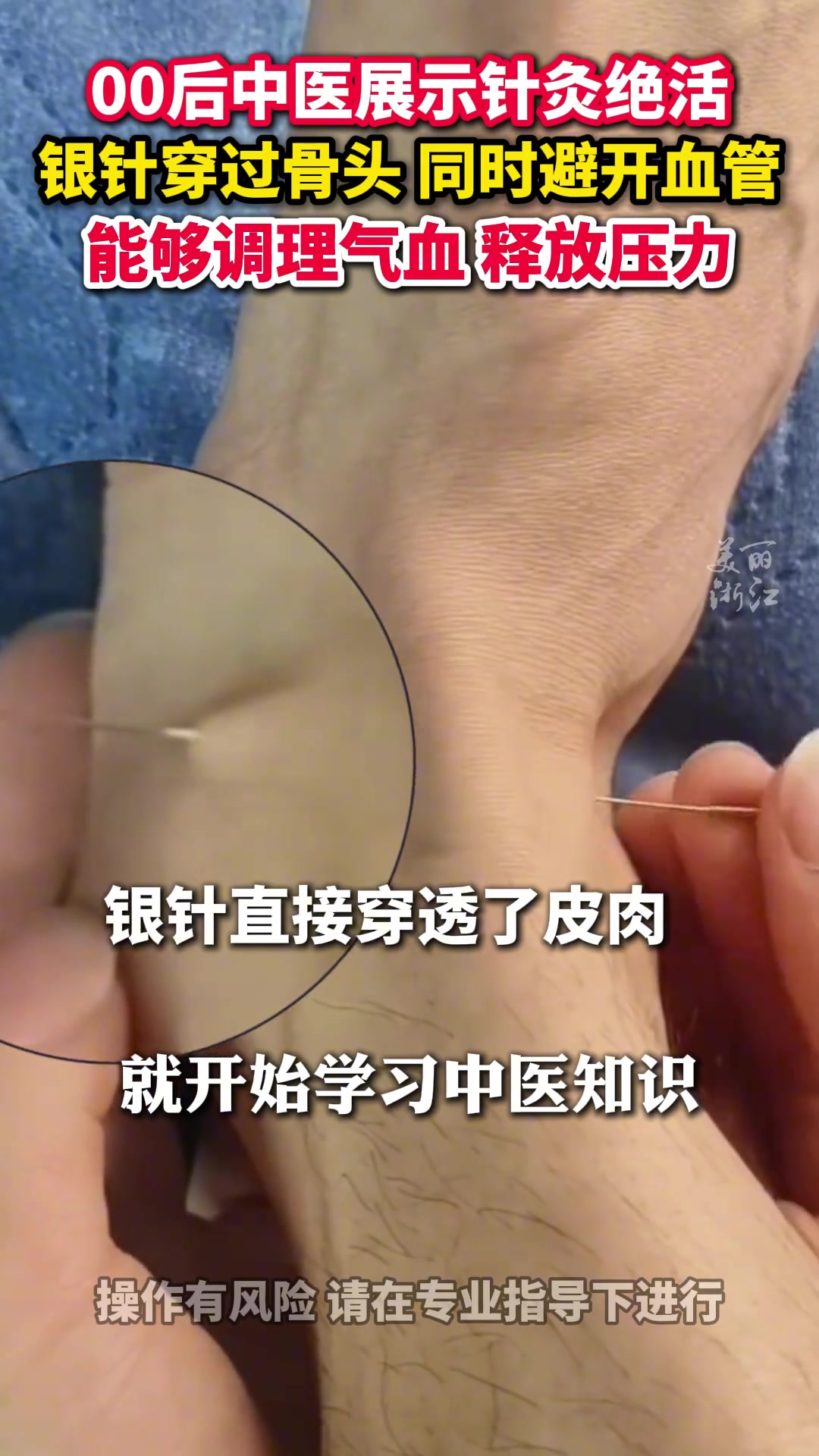 银针在骨头间穿插自如！00后中医展示针灸绝活看呆网友