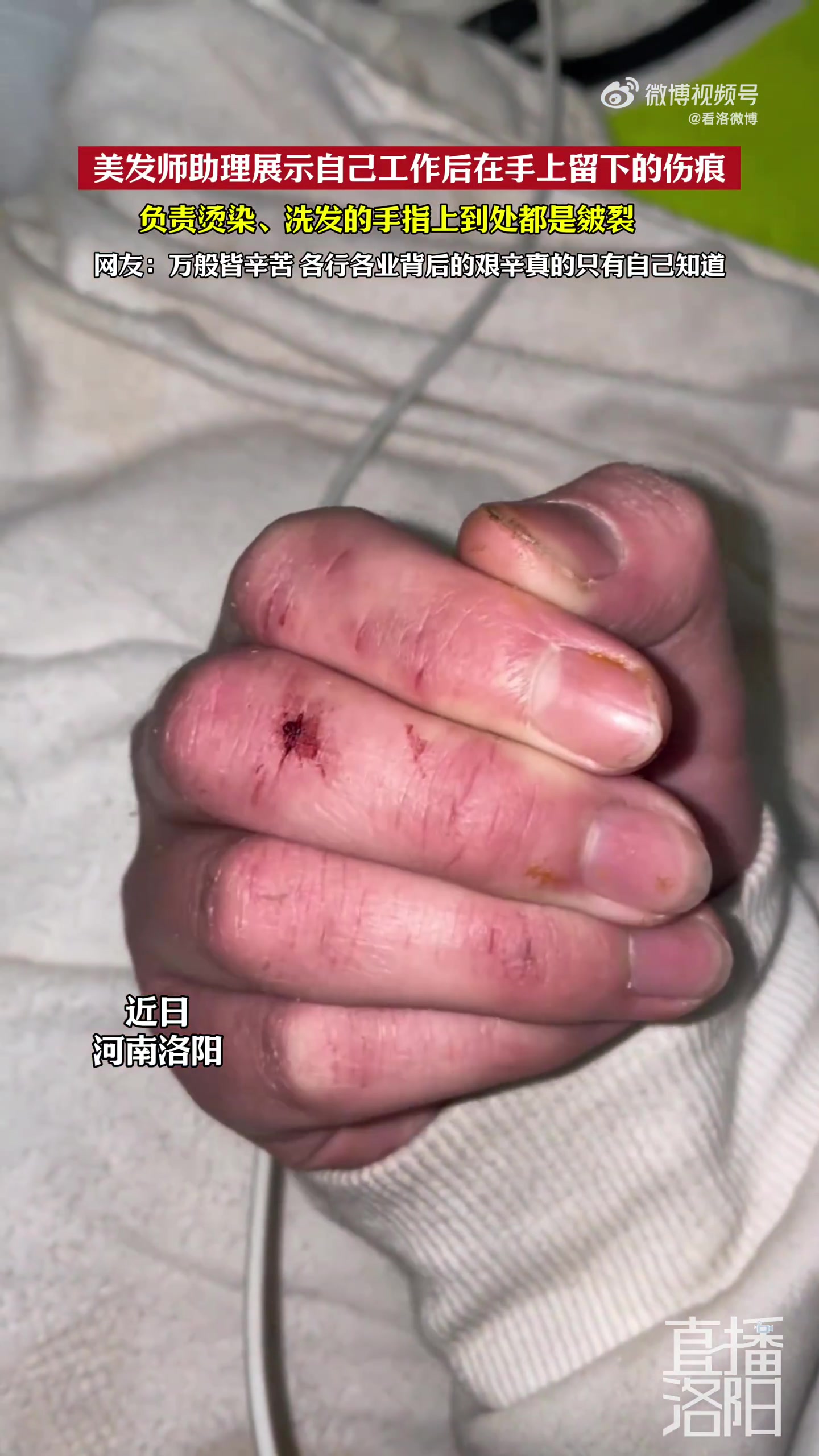 美发师助理展示自己工作后在手上留下的伤痕