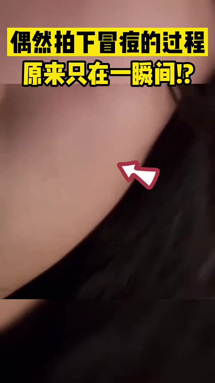 原来痘痘是突然冒出来的