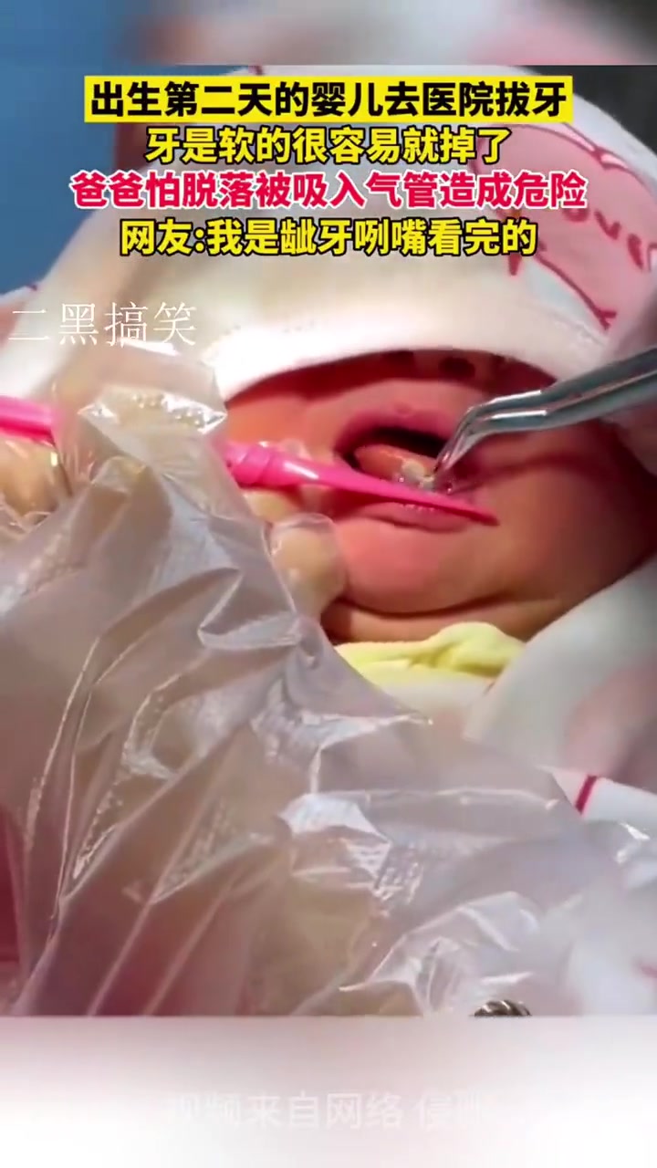 出生第二天的婴儿去医院拔牙，牙是软的很容易就拔掉