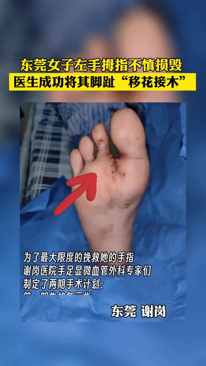 东莞女子左手拇指不慎损毁，医生成功将其脚趾移接