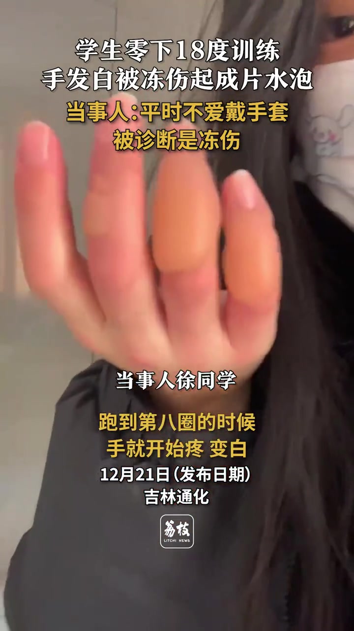 学生不戴手套零下18度训练，手指被冻伤成片起水泡
