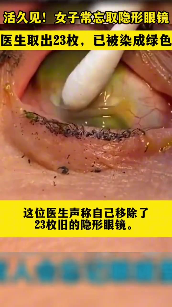 女子经常忘取隐形眼镜，医生取出23枚，已被感染成绿色