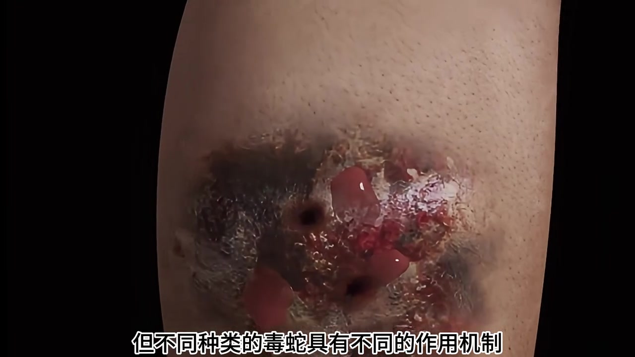 被毒蛇咬后会发生什么？！