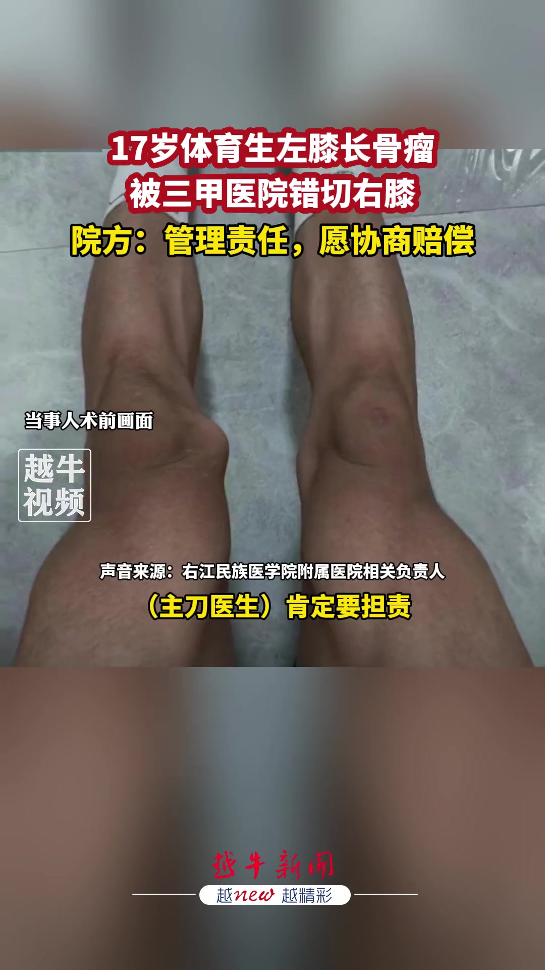 17岁体育生左膝长骨瘤，被三甲医院错切右膝