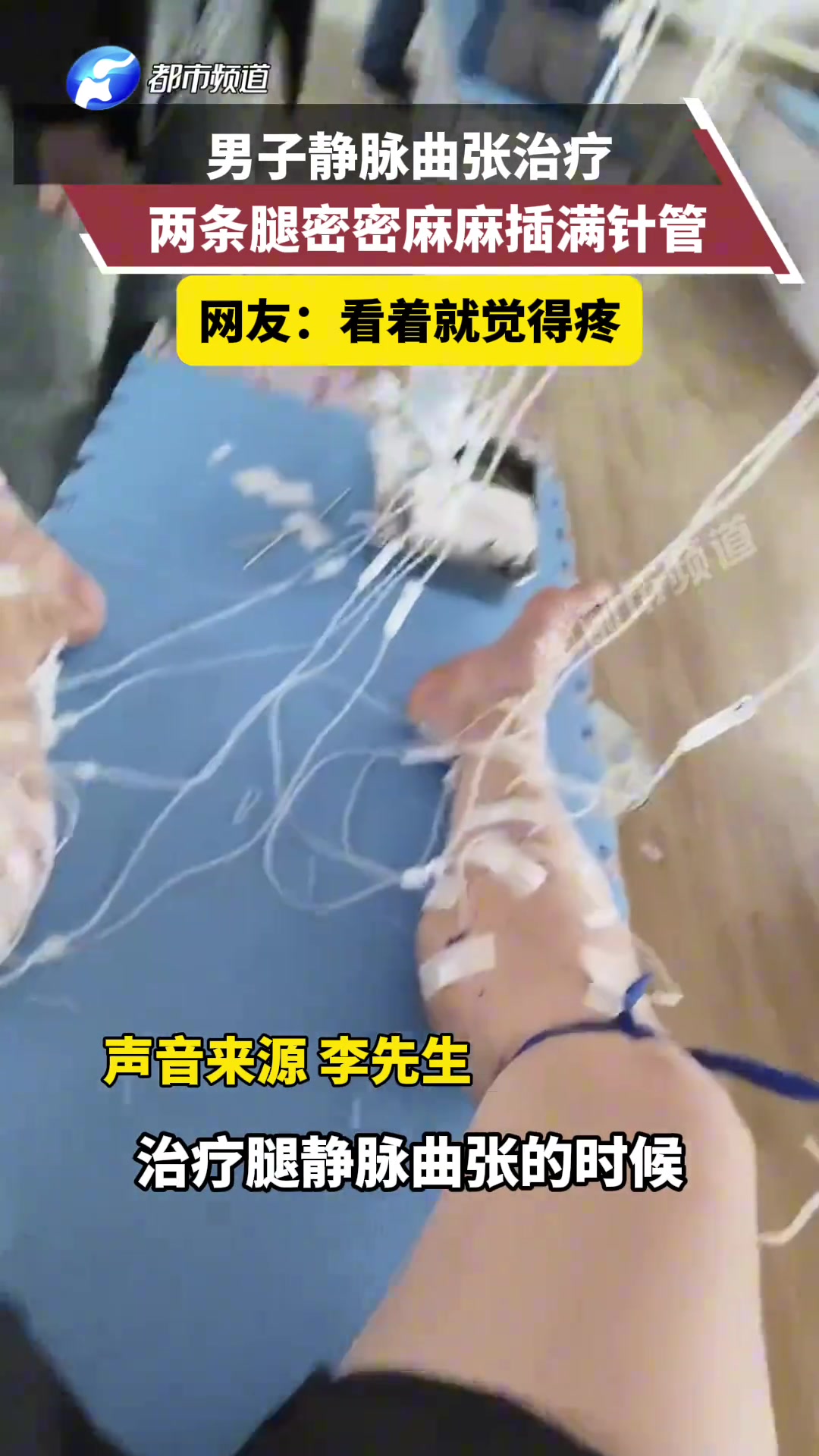 男子静脉曲张治疗，两条腿密密麻麻插满针管