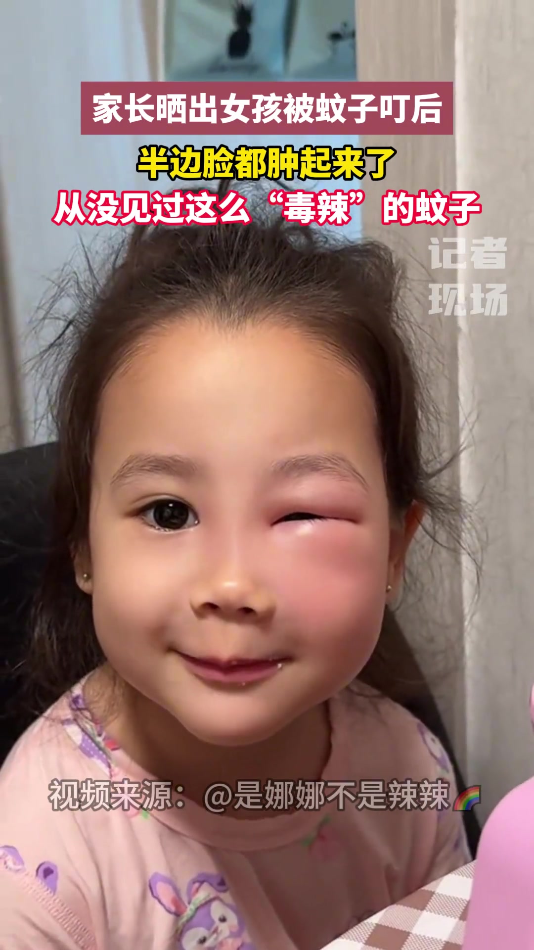 家长晒出女孩被蚊子叮后，半边脸都肿起来了