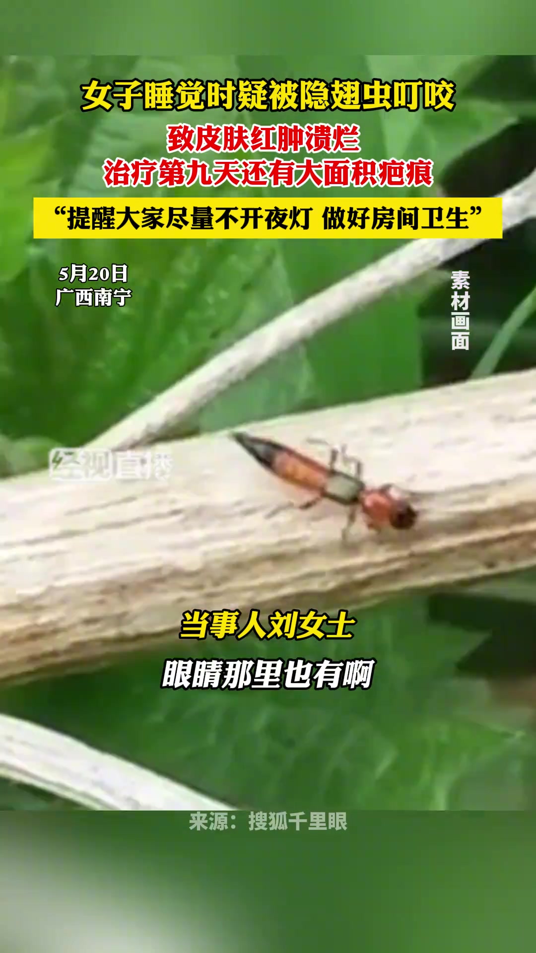 女子开夜灯睡疑被隐翅虫咬 治疗第9天还有大面积疤痕
