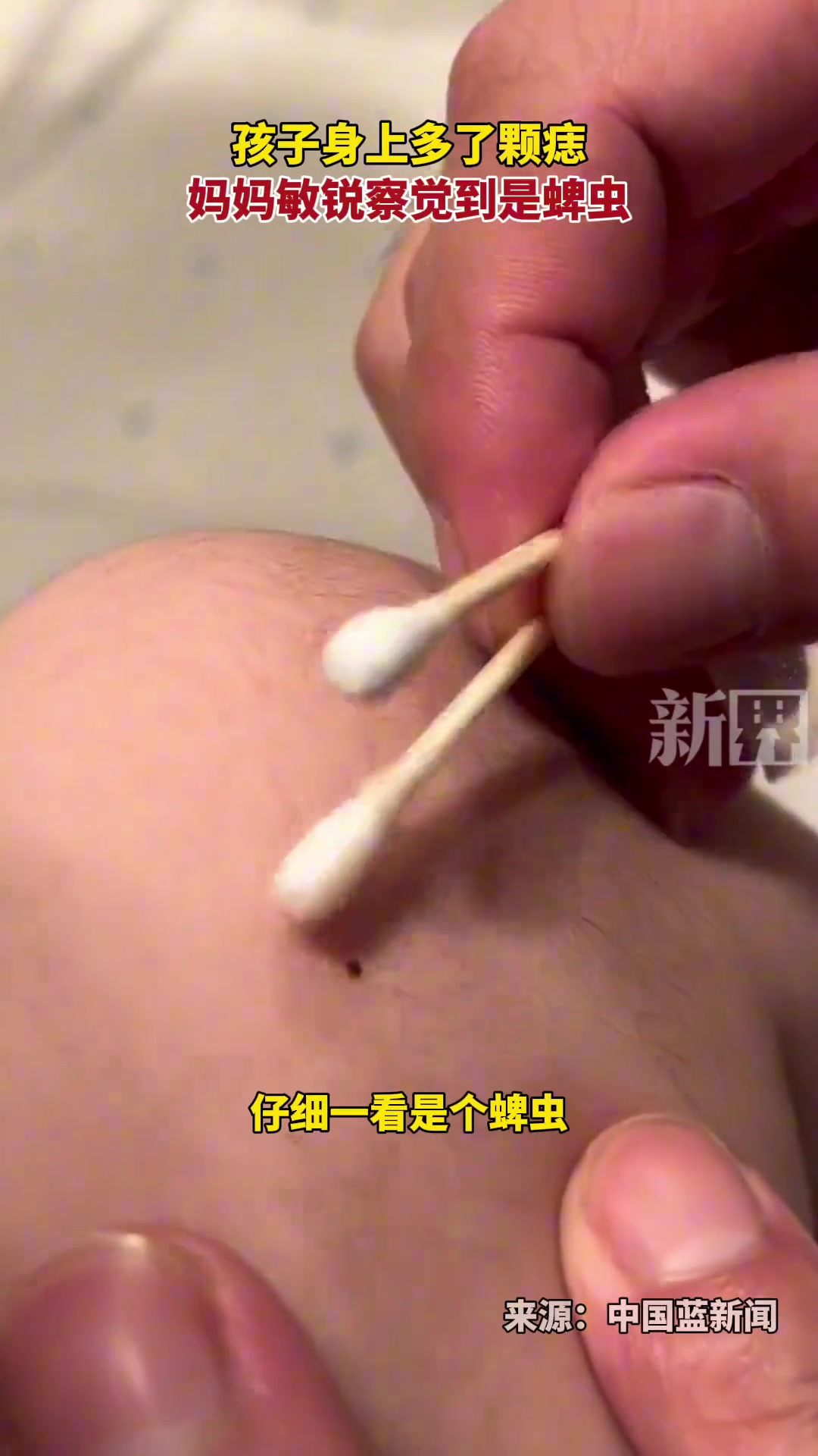孩子洗澡多颗痣，仔细一看虫子的头都钻进肉里了