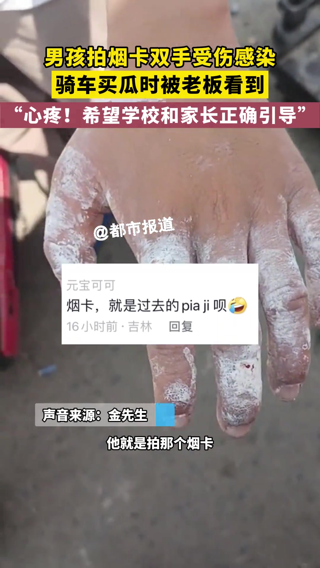 男孩拍烟卡双手受伤感染 卖瓜老板看了都心疼