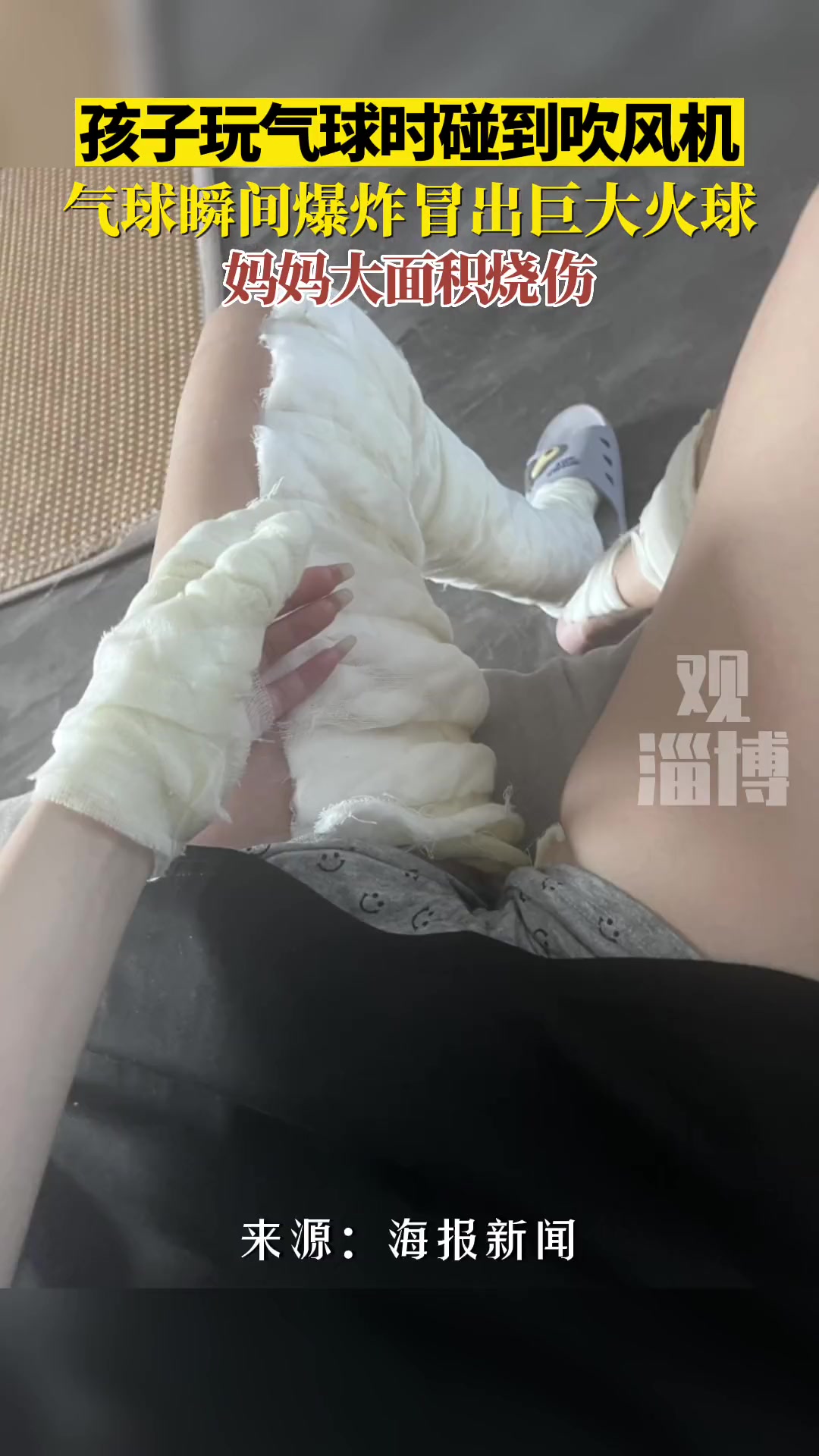 孩子玩气球时碰到吹风机 气球瞬间爆炸妈妈大面积烧伤
