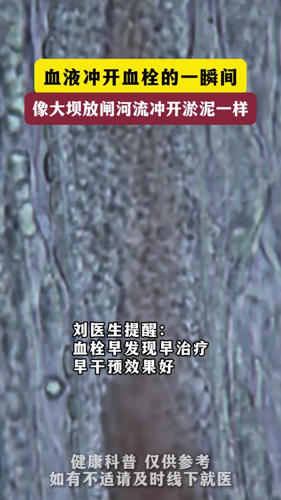 血液冲开血栓的瞬间！