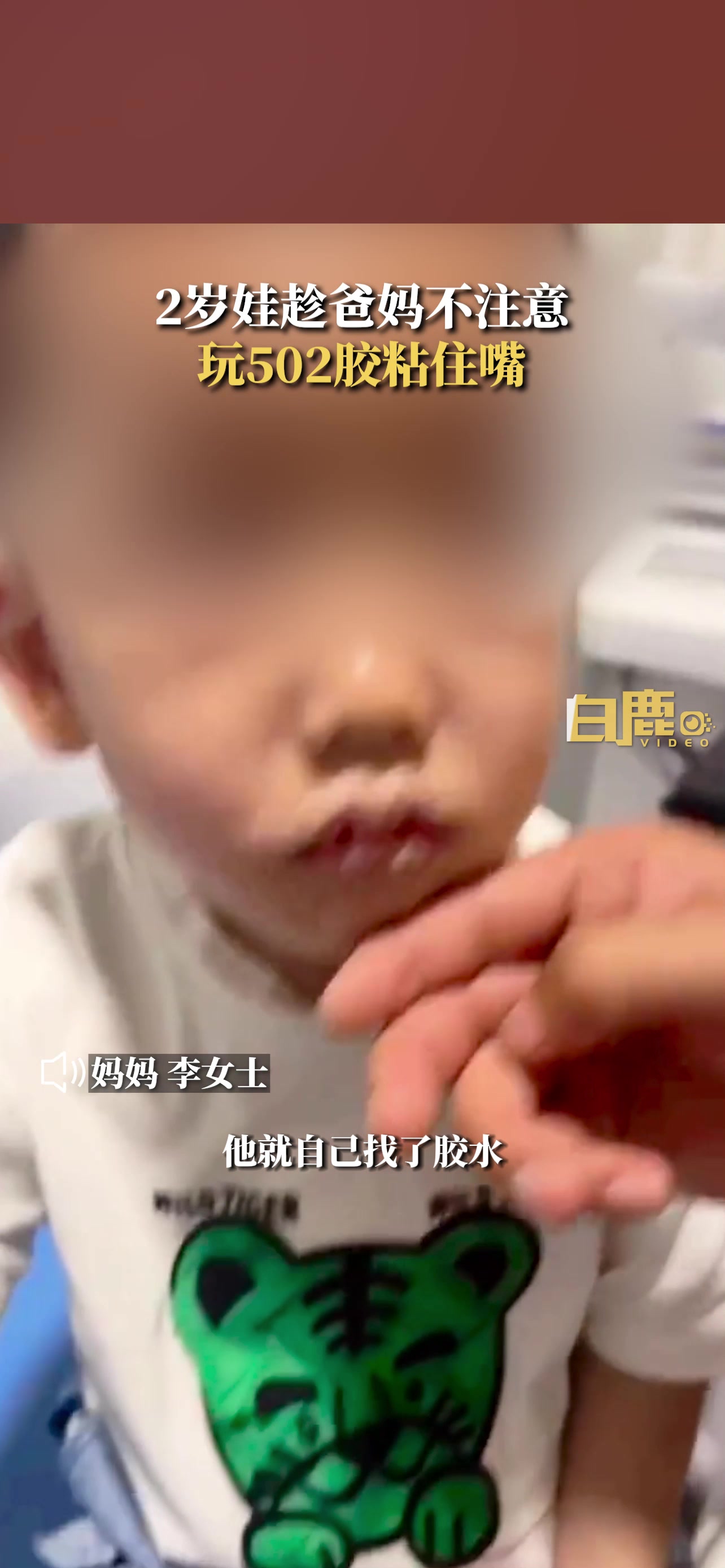 小孩不小心把502涂到嘴上，太危险了！还好没事！