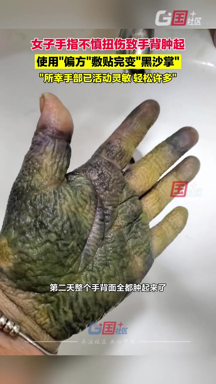 手指扭伤使用“偏方”敷贴完变黑沙掌