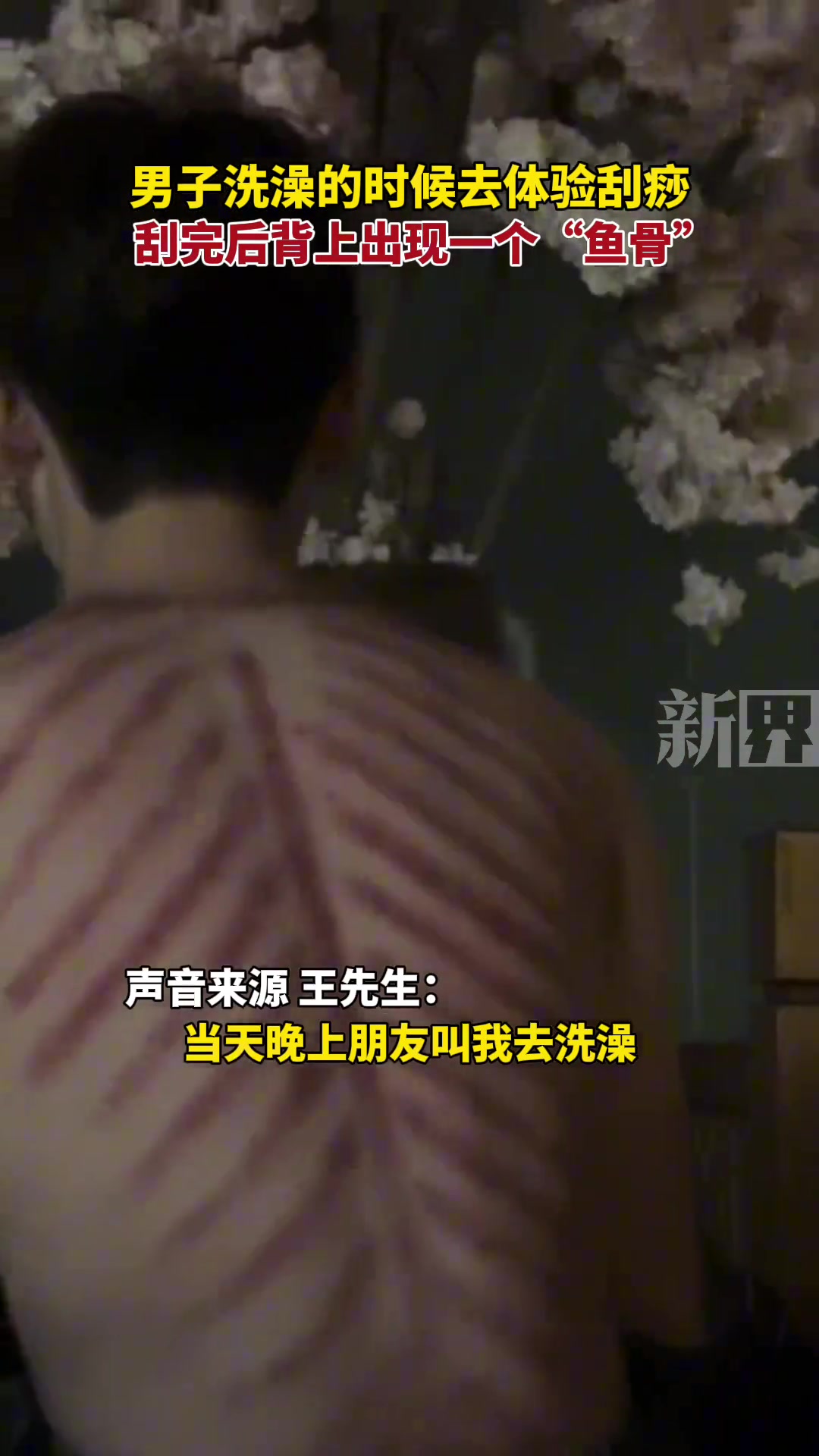 男子洗澡时去体验刮痧，刮完后背上出现一个“鱼骨”