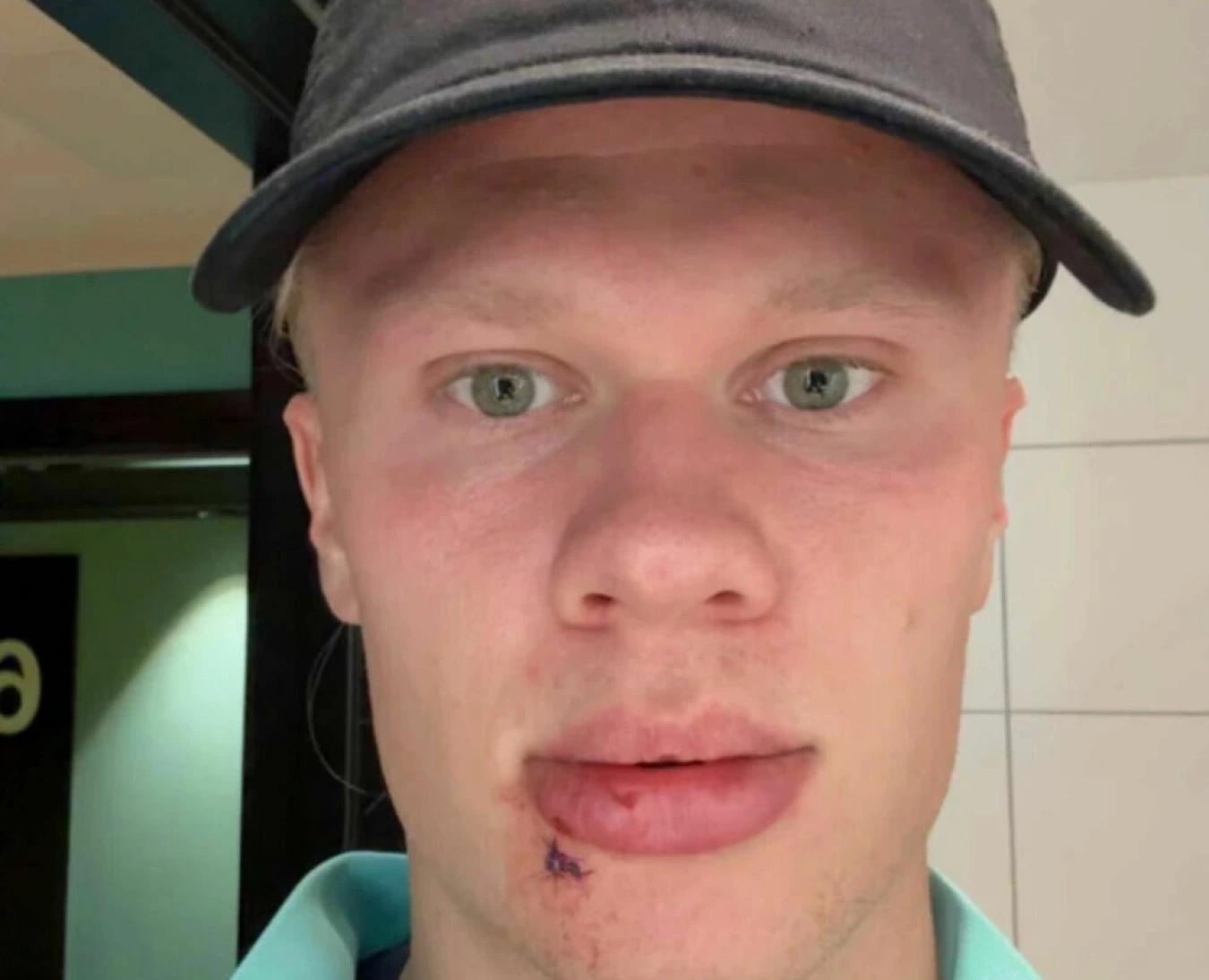 挪威主帅：哈兰德缝了几针且看过牙医，出战摩尔多瓦没问题