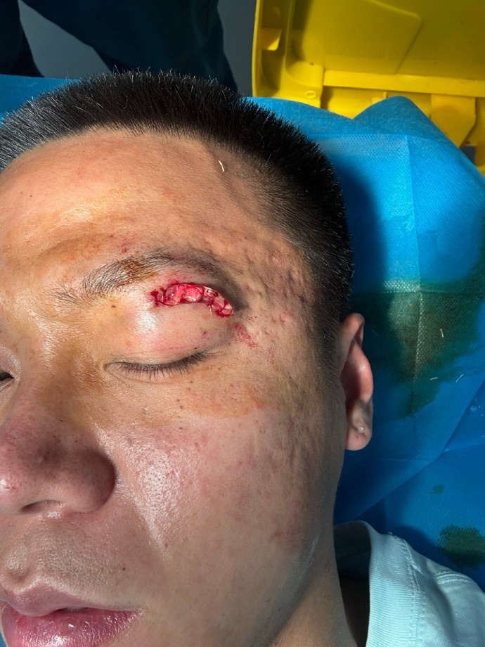 牛梓屹社媒晒眼部伤口照片：眼睛踢瞎