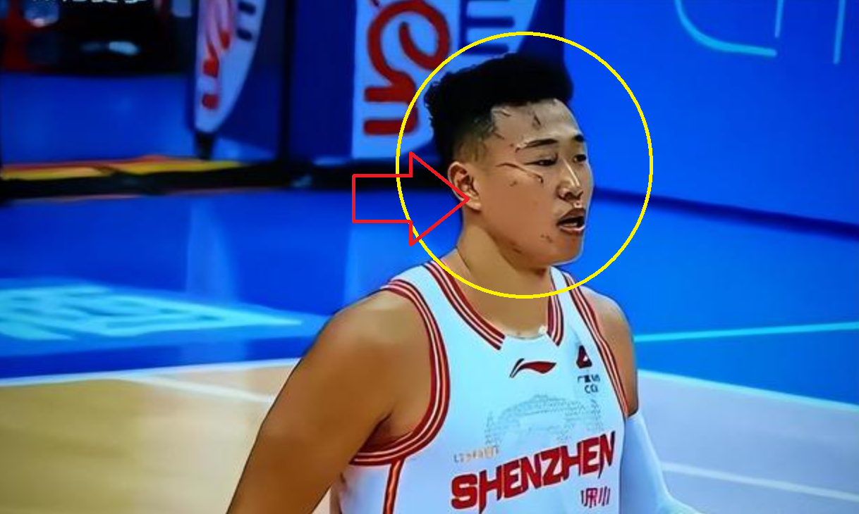 触目惊心！打了一场CBA比赛，整张脸都被“毁容”了球迷：可怕